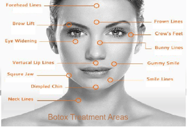 Botox injection sites for wrinkle reduction on a female face.