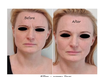 Före- och efterbild filler glabella – reducerade linjer och slätare panna.