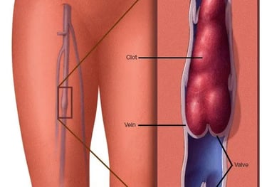 Venous thrombosis DVT Amman Jordan