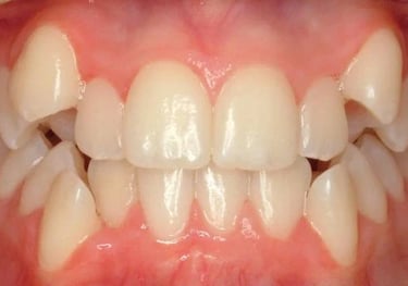 affordable tooth removal
