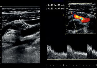 Duplex carotid ultrasound image showing vascular stenosis.