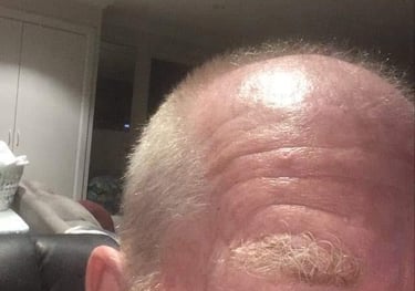 Martin Billington before his hair transplant