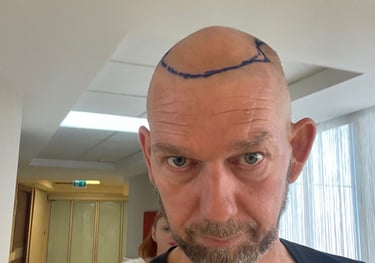 My head being prepared for hair transplant surgery in Izmir, Turkey