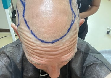 My head being prepared for hair transplant surgery in Izmir, Turkey