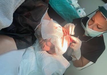 Extracting hair follicles for a hair transplant in Izmir, Turkey