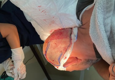 Extracting hair follicles for a hair transplant in Izmir, Turkey
