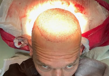 replaced hair follicles in a hair transplant in Izmir in Turkey