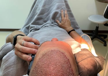 replaced hair follicles in a hair transplant in Izmir in Turkey