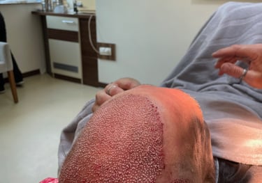 a finished hair transplant showing the freshly implanted hair follicles, Izmir, Turkey