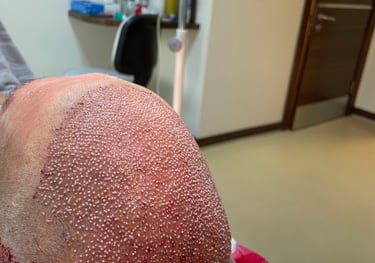 a finished hair transplant showing the freshly implanted hair follicles, Izmir, Turkey