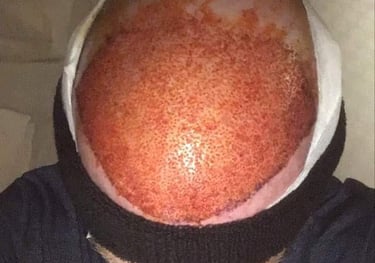 hair transplants that have just been complet