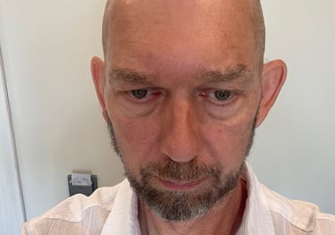 post operation pictures of a hair transplant on a man