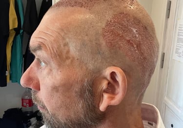post operation pictures of a hair transplant on a man