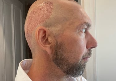 post operation pictures of a hair transplant on a man