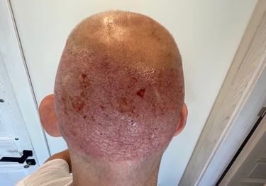 post operation pictures of a hair transplant on a man