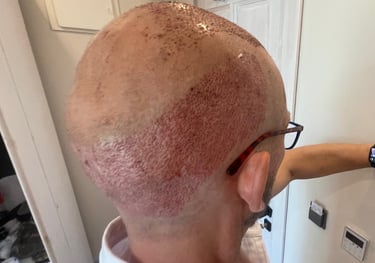 post operation pictures of a hair transplant on a man