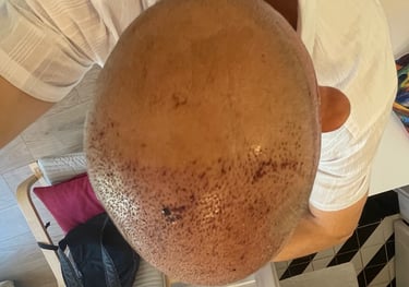 post operation pictures of a hair transplant on a man