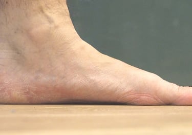 image of flat foot