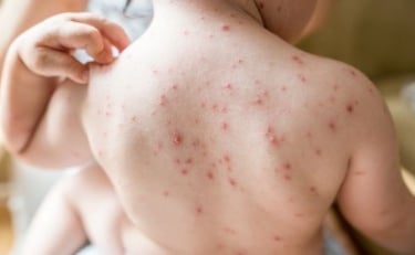 Bintik merah pada anak