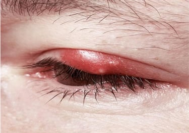 keluhan kelopak mata bengkak