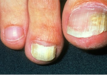 Penanganan Kuku Berjamur Klinik Sehat Plus BSD