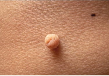 Pengangkatan Skin Tag Klinik Sehat Plus BSD