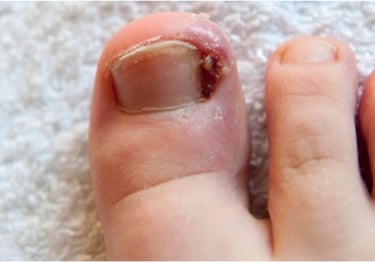 Penanganan Kuku Cantengan Klinik Sehat Plus BSD