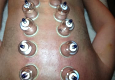 Cupping on back