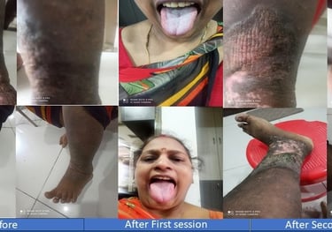 gangrene treatment without surgery Best chiropractor in Hyderabad