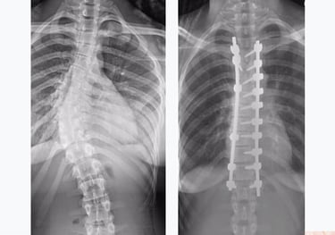 scoliosis treatment Best chiropractor in Hyderabad