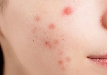 ultra repair medifacial for sensitive skin and acne marks