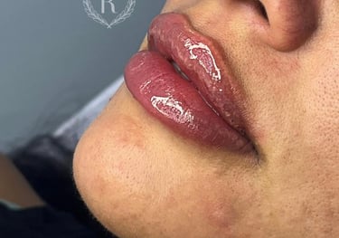 preenchimento facial com ácido hialurônico - Dra. Raphaela Dafne Tatuapé
