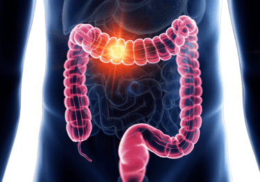 Colon cancer -Dr Maunil Tomar
