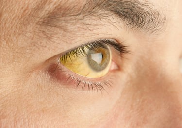 Jaundice Liver Cirrhosis