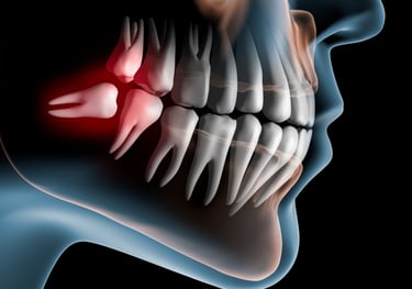 Picture showing impacted wisdom teeth