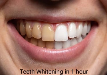 White straight teeth after teeth whitening at best dental clinic in Orlem Malad west Mumbai