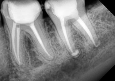 Best root canal treatment done at top dental clinic near Chincholi Malad west in Mumbai