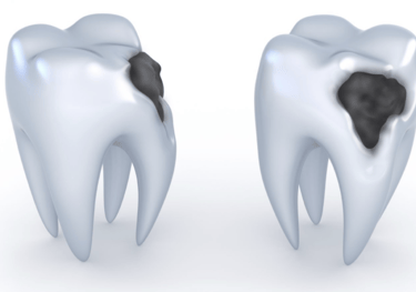 Illustration médicale 3D : molaires humaines avec carie et cavités sombres.