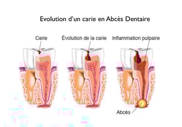 Évolution de la carie : de la cavité à l'abcès avec inflammation de la pulpe.