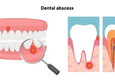 Schéma d'abcès : inflammation de la gencive et infection de la racine.