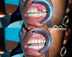 Pont dentaire : restauration d'une dent manquante chez un patient.