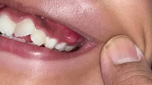 gencives enflées et abcès près des molaires (gingivite). Traitement en cours chez dentist237