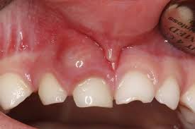 Abcès et gencive enflée au-dessus des dents de lait chez un enfant à nkolndongo Yaoundé