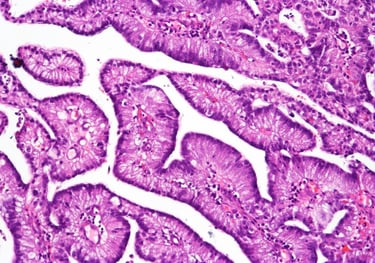 foto de microscópio de tecidos cancerígenos