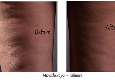 Mesotherapy before and after image against cellulite on thighs with smoother skin after 4 weeks.
