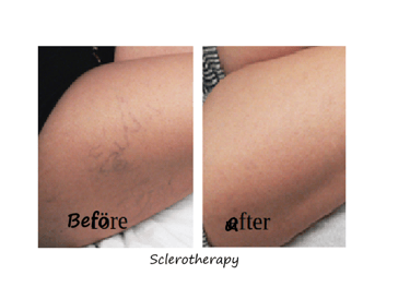 Before & after spider veins treatment Delhi – thigh veins cleared after sclerotherapy