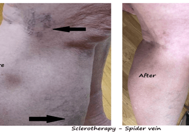 Before & after spider veins treatment Delhi – leg vein clusters reduced after sclerotherapy.