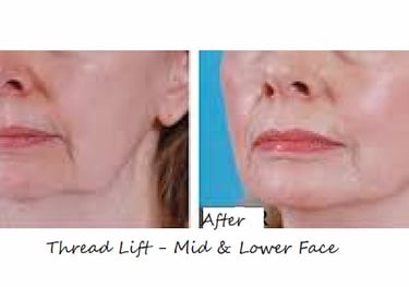 Before and after thread lift in mid and lower face with skin tightening.