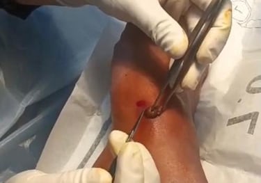 Medical professional performing a minor surgical procedure on a patient's foot using sterile tools.