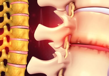 3D anatomic illustration showing disc degeneration in the lower back.